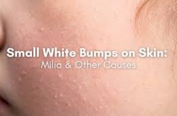 Clear Skin Guide: Seven Reasons for White Bumps and Solutions
