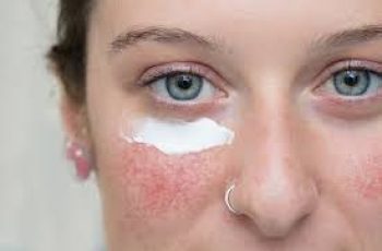 Skincare Solutions for Blotchy Skin: Causes, Treatments, and Prevention