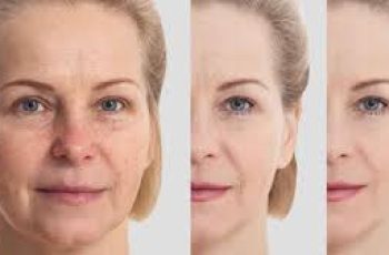 Microneedling and Lactic Acid: Safe Timing and Skincare Guidelines