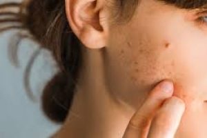 Lactic Acid and Skin Purging: Signs, Timeline, and What to Expect