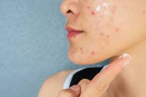 Cheek Acne Explained: Causes and Effective Home Skin Care Treatments