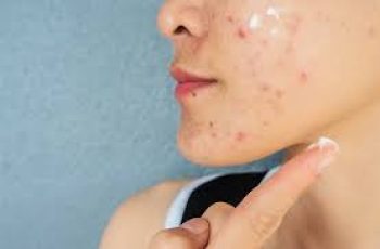 Cheek Acne Explained: Causes and Effective Home Skin Care Treatments Cheek Acne Explained: Causes and Effective Home Skin Care Treatments