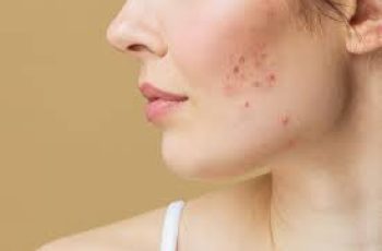 Understanding Cystic Acne for Better Skin Care and Effective Treatment