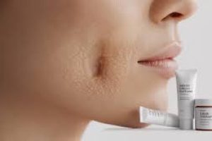 Complete Skincare Guide to Preventing, Treating, and Removing Blackheads