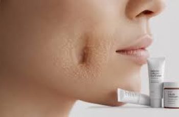 Complete Skincare Guide to Preventing, Treating, and Removing Blackheads Complete Skincare Guide to Preventing, Treating, and Removing Blackheads