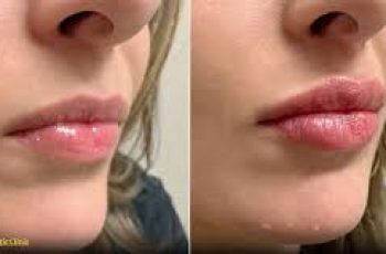 Dermal Fillers and Skincare: Should You Worry About Filler Migration? Dermal Fillers and Skincare: Should You Worry About Filler Migration?