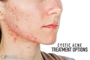 How Long Acne Takes to Clear: A Dermatologist Skincare Guide