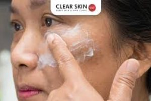 Targeted Skincare Solutions for Hyperpigmentation Around the Mouth