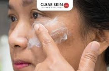 Targeted Skincare Solutions for Hyperpigmentation Around the Mouth