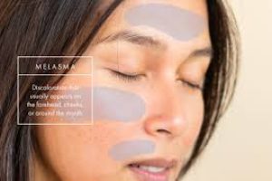 How Internal Skincare and Nutrition Help Reduce Melasma
