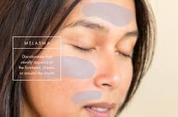 How Internal Skincare and Nutrition Help Reduce Melasma