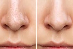 Still Have Blackheads? What Your Cleanser Can and Can’t Do