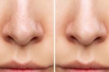 Still Have Blackheads? What Your Cleanser Can and Can’t Do