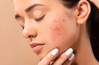 Ask the Dermatologist: Common Acne Myths That Hurt Your Skin