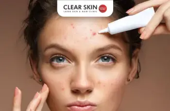 How Long Does It Take to Get Rid of Acne? A Dermatologist’s Guide to Clearer Skin How Long Does It Take to Get Rid of Acne? A Dermatologist’s Guide to Clearer Skin