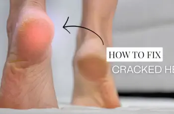 How to Transform Cracked Heels for Sandal Season | Exfoliating Foot Treatment How to Transform Cracked Heels for Sandal Season | Exfoliating Foot Treatment