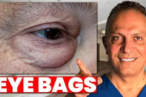 How to Get Rid of Bags Under Your Eyes: Causes, Remedies & Expert Tips