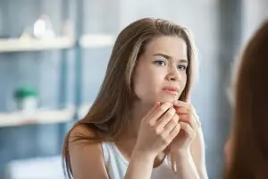 How to Get Rid of Acne: 8 Natural Treatments for Pimples